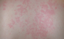 Image of AOSD rash