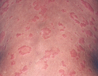 Image of Cryopyrin-Associated Periodic Syndrome (CAPS) rash