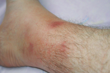 Image of Familial Mediterranean Fever (FMF) rash.