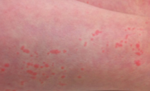 Image of SJIA rash