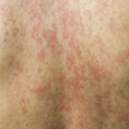 Image of TRAPS rash