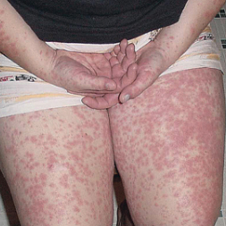 Image of HIDS/MKD rash